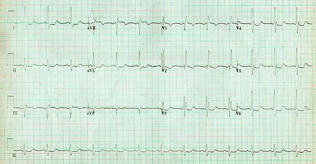 Right bundle branch block 5.png