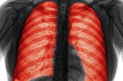 File:COPD.jpg