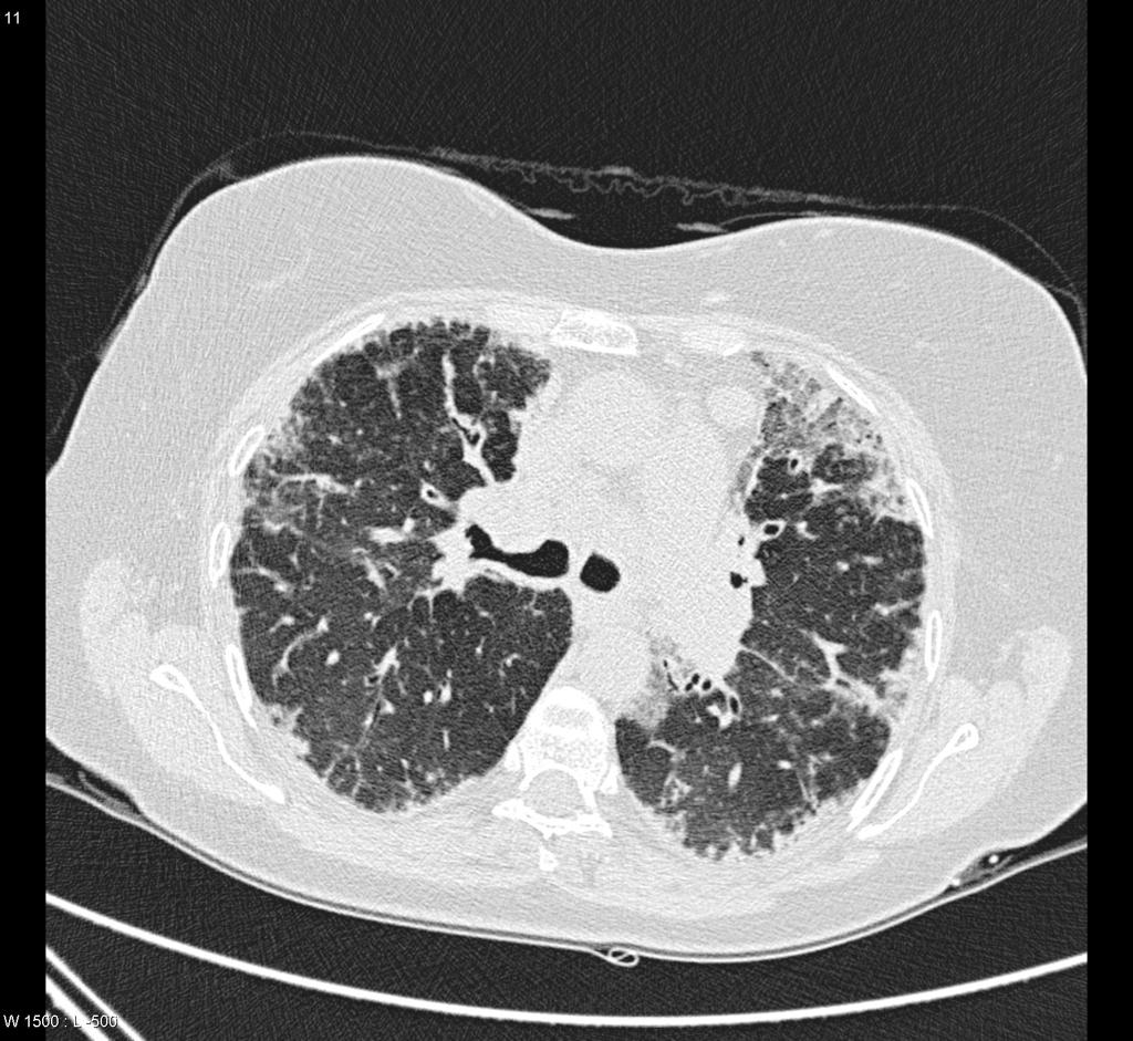 File:Eosinophilic-lung-disease-chronic-1.jpg