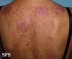 Lupus Erythematosus-Subacute Cutaneous Lupus Erythematosus. Adapted from Dermatology Atlas.[17]