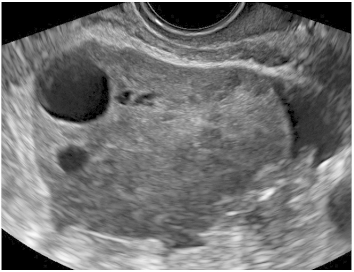 File:Ovarian fibroma with cystic changes.jpg