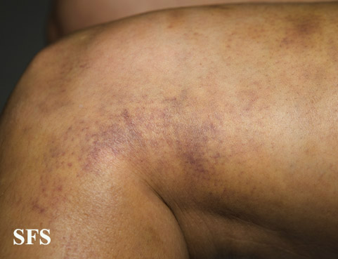 File:Painful bruising syndrome07.jpg