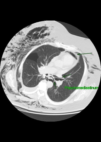 Pneumomediastinum and pneumothorax and subcutaneous emphysema