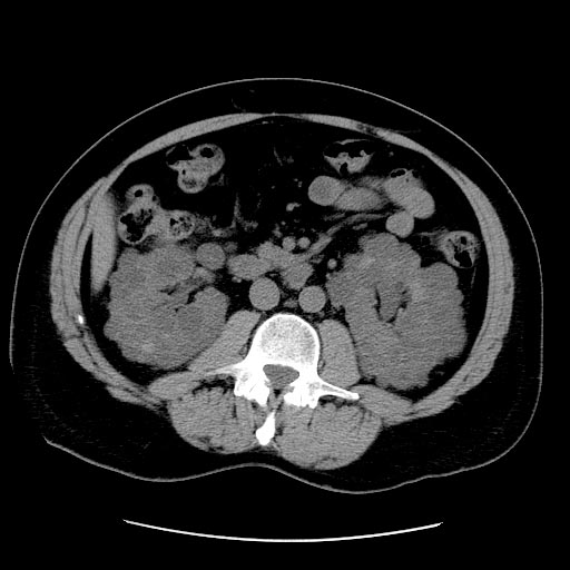 File:Polycystic-kidneys-001.jpg
