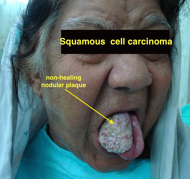 File:Squamous cell carcinomaa.jpg