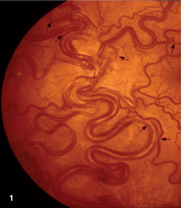 File:AVMs of the whole retina.jpg