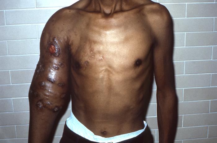Patient with nocardiosis infection of his right upper arm due to Gram-positive Nocardia brasiliensis bacteria, which manifested into a cellulitic inflammation known as an actinomycotic mycetoma. From Public Health Image Library (PHIL). [5]