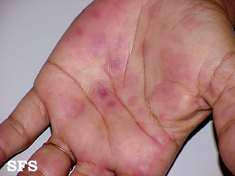 Erythema multiforme Adapted from Dermatology Atlas.[1]