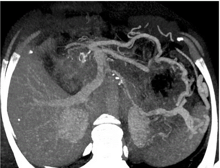 File:MRI splenic vein thrombosis.gif