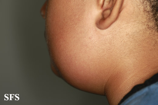 Parotid swelling With permission from Dermatology Atlas.[1]
