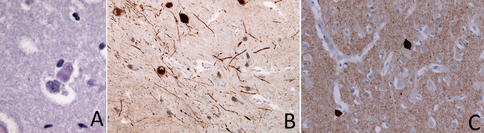 File:Pathology alpha synuclein DLB dementia with lewy bodies autopsy.jpg