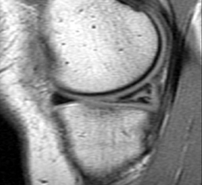 File:Tear-posterior-horn-medial-meniscus-001.jpg
