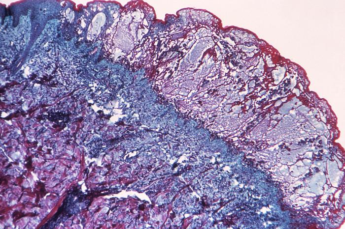 Hematoxylin-eosin (H&E)-stained photomicrograph reveals some of the cytoarchitectural histopathologic changes found in a human skin tissue specimen that included a varicella zoster virus lesion (50x mag). From Public Health Image Library (PHIL). [8]
