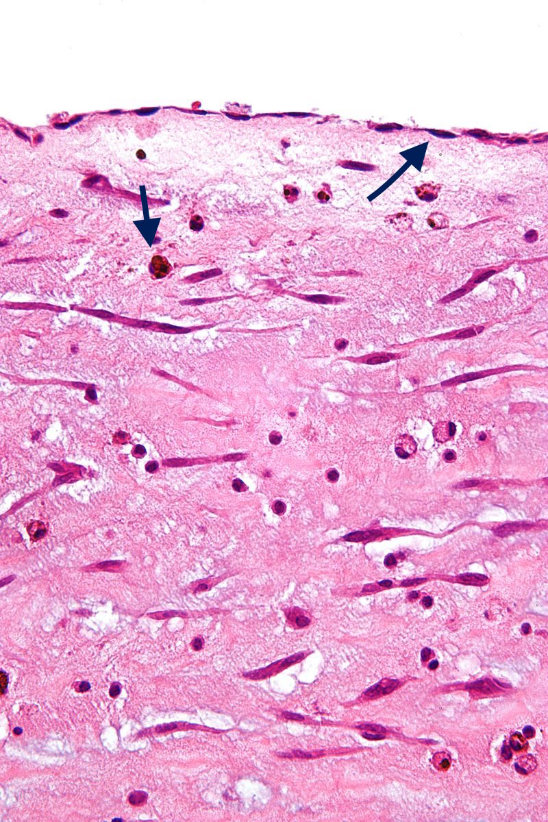 Black arrow (top): Endothelium Black arrow (bottom): Hemosiderin macrophage. Case courtesy of Nephron [CC BY-SA 3.0 (https://creativecommons.org/licenses/by-sa/3.0)]