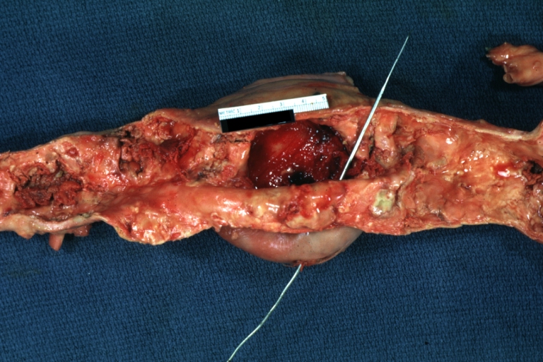 Atherosclerotic Aneurysm: Gross, very good example of ruptured thoracic segment