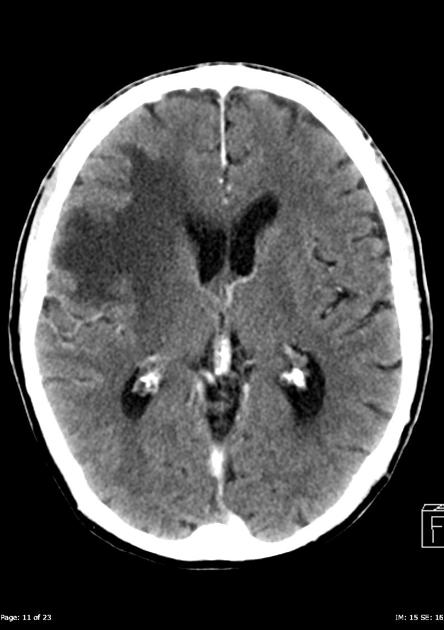 Contrast CT scan of a 85 year olf male with metastatic renal cell carcinoma, complaining of recent-onset headache, demonstrates a well-defined, vividly contrast enhancing mass identified in the right frontal lobe measuring 25 x 20 x 18 mm. The mass demonstrates a thick contrast-enhancing rim and a 6 x 6 mm focus of central hypodensity/necrosis. There is extensive surrounding vasogenic edema resulting in mass-effect with sulcal effacement, effacement of the right lateral ventricle, and 3 mm left-sided midline shift. No other mass, focal abnormality, intra or extra-axial collection is identified. Ventricles and basal cisterns are within normal limits and age appropriate.[12]