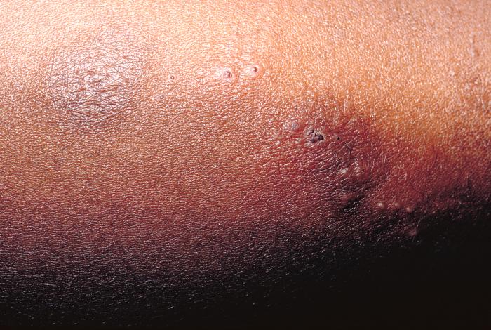Vaccine recipient developed a secondary herpes infection adjacent to the vaccination site. From Public Health Image Library (PHIL). [1]