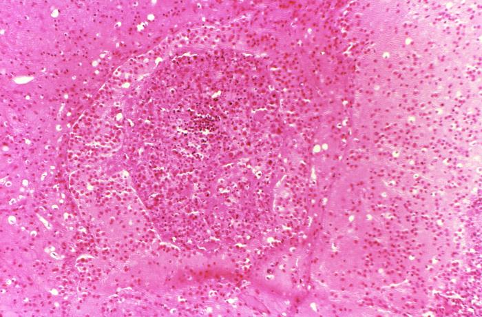 "Hematoxylin-eosin (H&E)-stained photomicrograph of a mediastinal lymph node tissue sample revealed the presence of histopathologic changes indicative of an occluded blood vessel in a case of fatal human anthrax.” Adapted from Public Health Image Library (PHIL), Centers for Disease Control and Prevention.[20]
