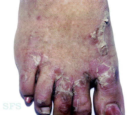 Epidermolysis bullosa simplex. Adapted from Dermatology Atlas.[1]