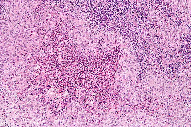 Langerhans cell histiocytosis - high mag.jpg