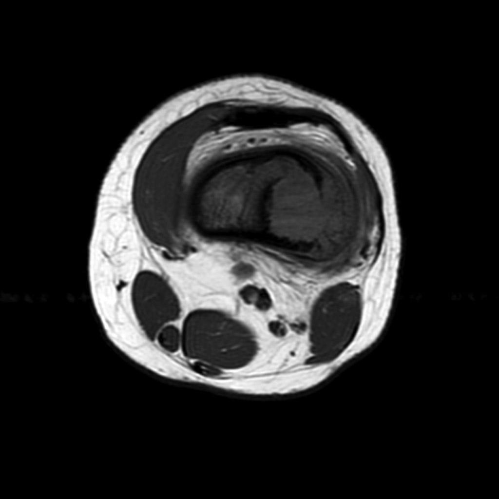 File:Osteosarcoma-distal-femur (5).jpg