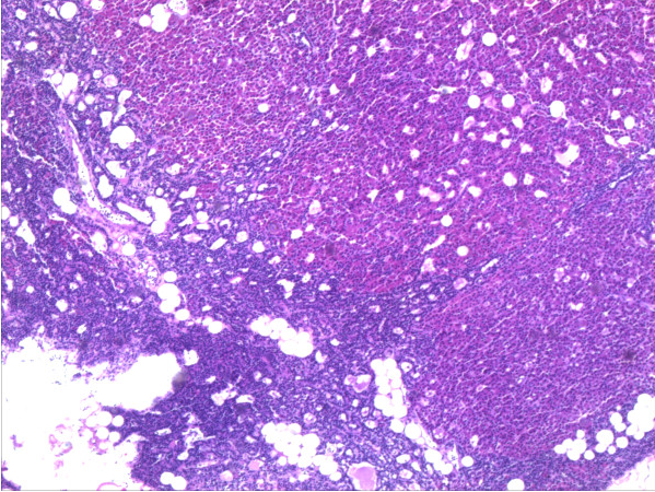 Hyperplasia of parathyroid gland HE-staining, 20× magnification. Source: Wikipedia. Biomedcentral For original file click here.Creative Commons lisence