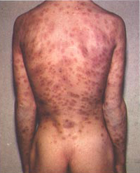 Syphilis lesions on a patient's back - By Office of Medical History, US Surgeon General - Adapted from http://history.amedd.army.mil/booksdocs/wwii/internalmedicinevolIII/chapter20figure64.jpg, Public Domain, https://commons.wikimedia.org/w/index.php?curid=1202157