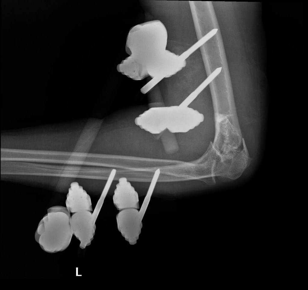 File:Displaced-t-condylar-and-supracondylar-fracture-of-the-distal-humerus (9).jpg