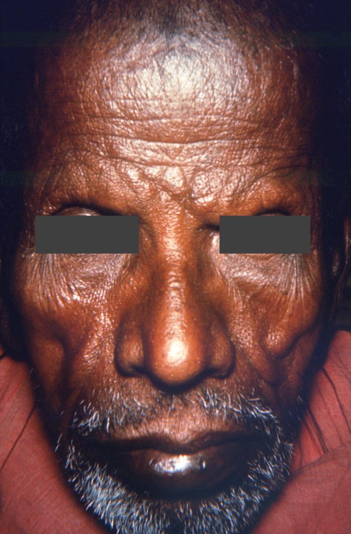Pathologic characteristics associated with a case of lepromatous or multibacillary leprosy. Note absence of eyebrows. Adapted from Public Health Image Library (PHIL), Centers for Disease Control and Prevention.[5]