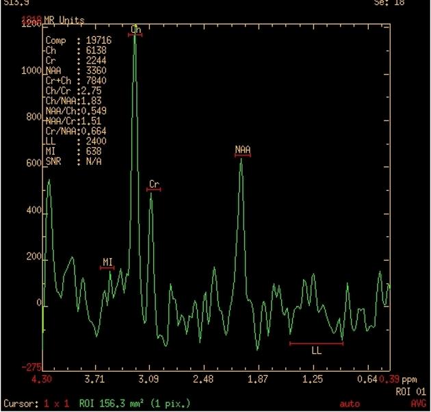 MR spectroscopy of the lesion demonstrating elevation of the choline and lipid lactate peaks and depression of the neural markers; N-acetyl aspartate (NAA) and creatine (Cr).[29]
