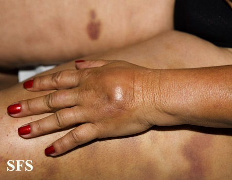 Painful bruising syndrome. With permission from from Dermatology Atlas.[5]