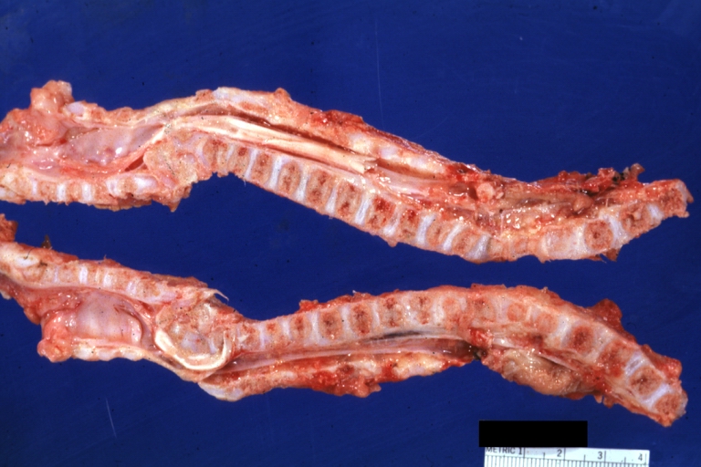 Spinal cord: Malformation Vertebral Bodies: Gross natural color sagittal section spinal column with malformation in region C7 T1 associated with Arnold Chiari malformation