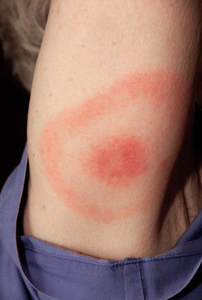Pathognomonic erythematous rash in the pattern of a “bull’s-eye”. Patient subsequently contracted Lyme disease. From Public Health Image Library (PHIL). [1]