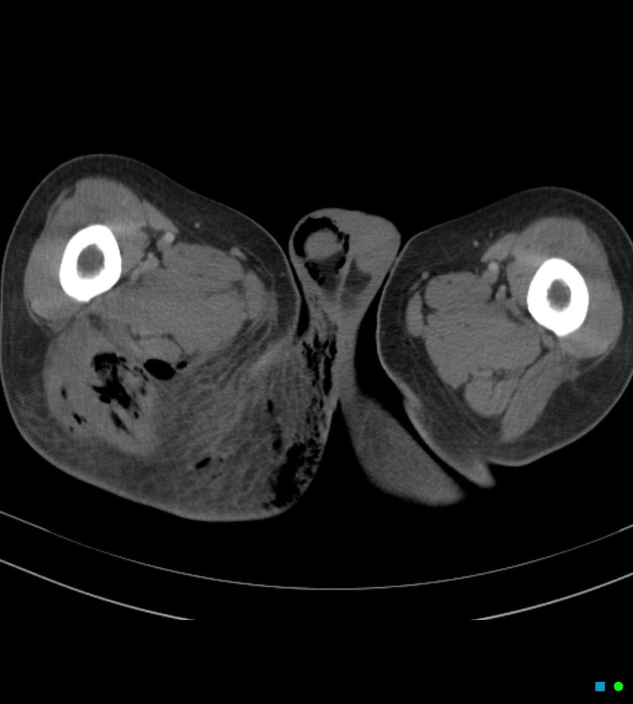 CT of Fournier gangrene with spontaneous perforation of rectal cancer [19]