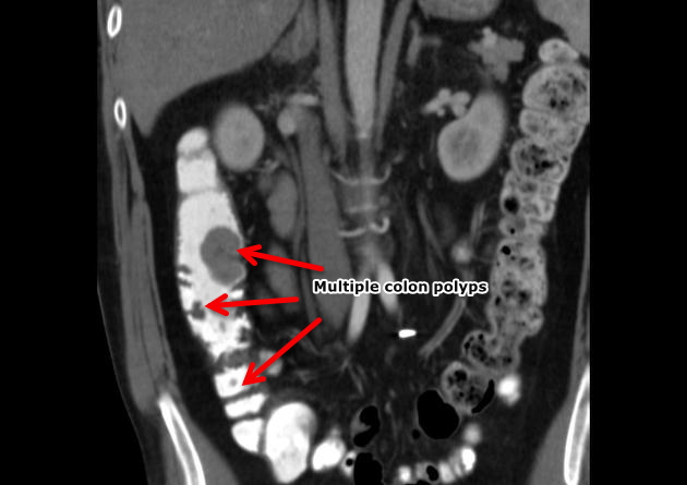 File:Coronal CT colon polyps.jpeg
