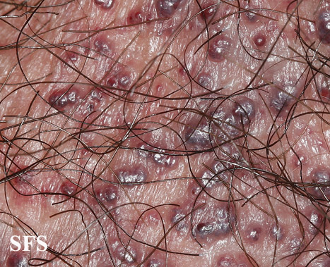 Fordyce,s spot. Adapted from Dermatology Atlas.<ref name="Dermatology Atlas">{{Cite
