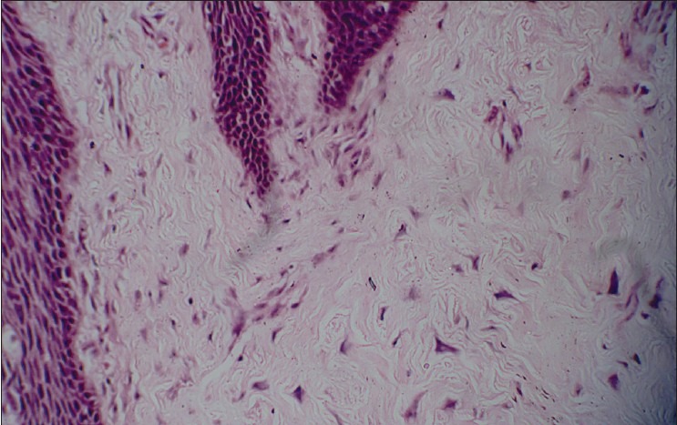 File:Giant cell fibroma 2.jpg