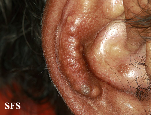 Tophi on ear. Note the associated inflammation[1]