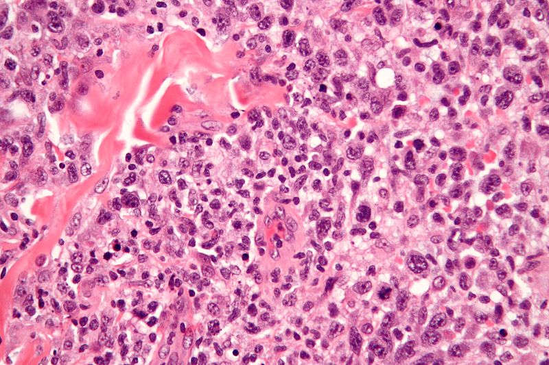 File:800px-Anaplastic large cell lymphoma - very high mag.jpg