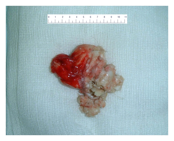 The macroscopic image of the surgical extract of a submental dermoid cyst with clear evidence of cystic formation containing smegma and hair, indicative of a dermoid cyst.[4]