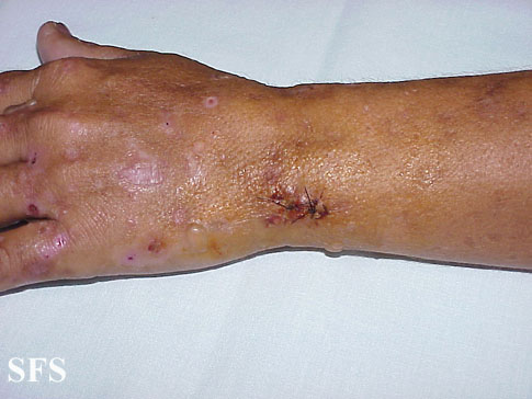 Porphyria cutanea tarda. With permission from Dermatology Atlas.[1]