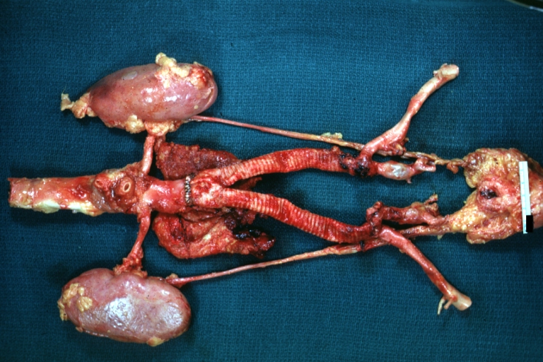 Aortobifemoral Prosthesis: Gross, natural color, nice dissection showing Dacron prosthesis replacing abdominal segment of aorta with portion of atherosclerotic aneurysm with renal arteries and kidneys
