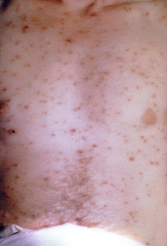 Chickenpox in an unvaccinated adult.