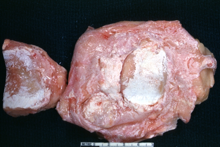 Bone, synovium: Gout: Gross natural color opened joint with extensive white deposits of uric acid