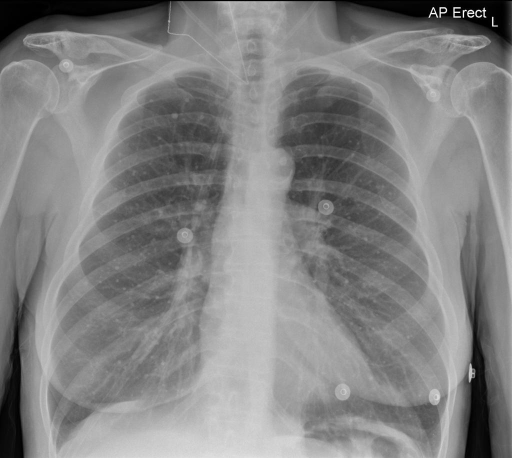 Chest x-ray of an adult female demonstrates multiple tiny subcentimeter calcific miliary opacities noted throughout both lungs. These are of uniform size and dense suggesting calcification. There is no focal lung parenchymal mass or cavitating lesion seen. The appearances are characteristic for healed varicella pneumonia.[4]