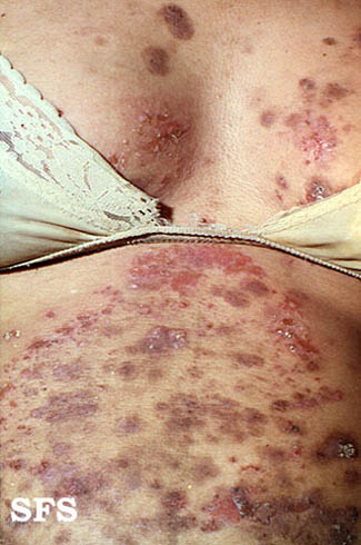url = http://www.atlasdermatologico.com.br/disease.jsf?diseaseId=181>