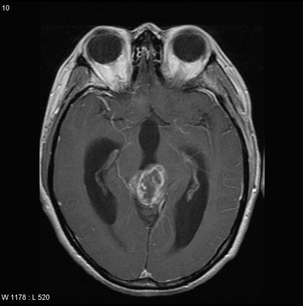 Axial T1 with contrast demonstrating a large enhancing mass is present in the pineal region compressing the tectum and resulting in obstructive hydrocephalus.[29]