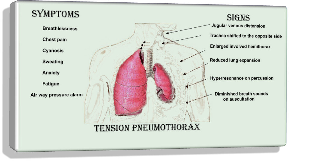File:Tension pneumothorax 11.jpg