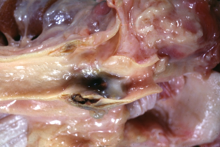 Carotid artery: Atherosclerosis: Gross, plaque with hemorrhage in carotid bulb