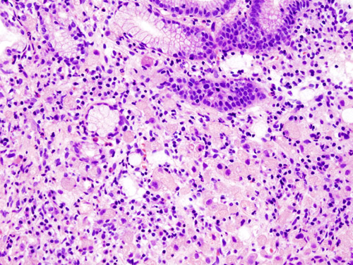 Gastric signet ring cell carcinoma. H&E stain.[9]